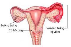 Bệnh viêm vòi trứng có nguy hiểm cho nữ giới không 1