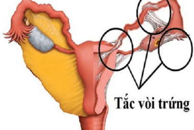 tắc 1 bên vòi trứng có thai được không