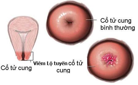 hình ảnh viêm lộ tuyến cổ tử cung ở 3 cấp độ 1