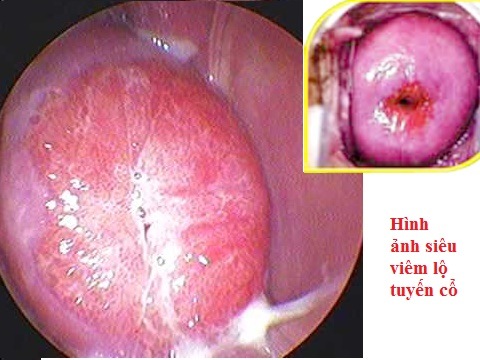 hình ảnh viêm lộ tuyến cổ tử cung độ 2