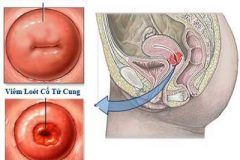 5 dấu hiệu viêm cổ tử cung sau sinh 1