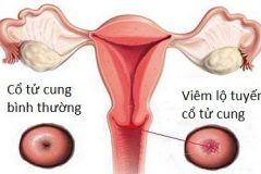 Bệnh viêm lộ tuyến cổ tử cung có nguy hiểm không 1