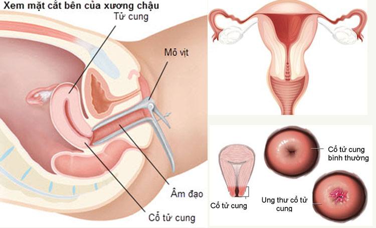 Chữa viêm lộ tuyến cổ tử cung bằng lá trầu không ? 2