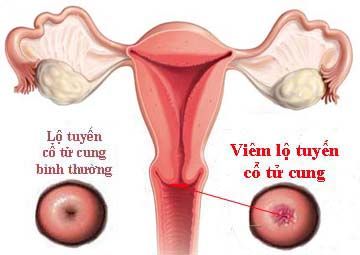 viêm lộ tuyến cổ tử cung là gì 