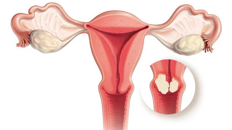 bị polyp cổ tử cung có sinh thường được không ?
