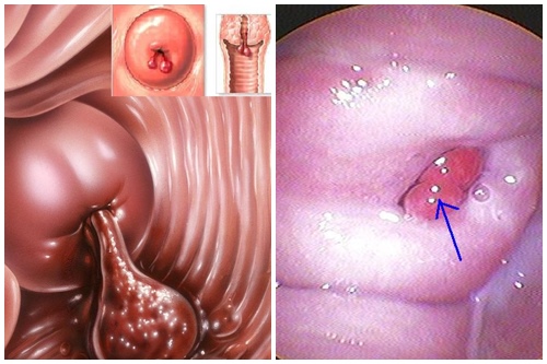 Bị polyp cổ tử cung có nguy hiểm không vậy 1